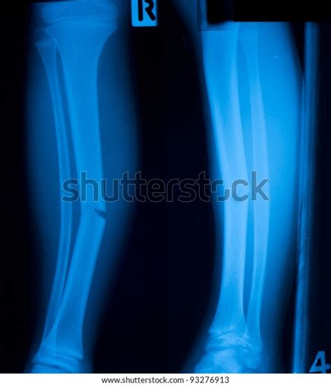 X Ray Film Tibia Leg Fracture Stock Photo (Edit Now) 93276913