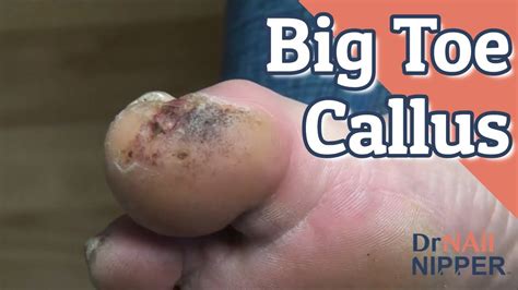 Big Toe Callus Part 1 Throwback Thursday Dr Nail Nipper