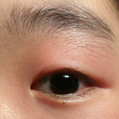 Can Eye Makeup Cause Eyelid Swelling Saubhaya Makeup