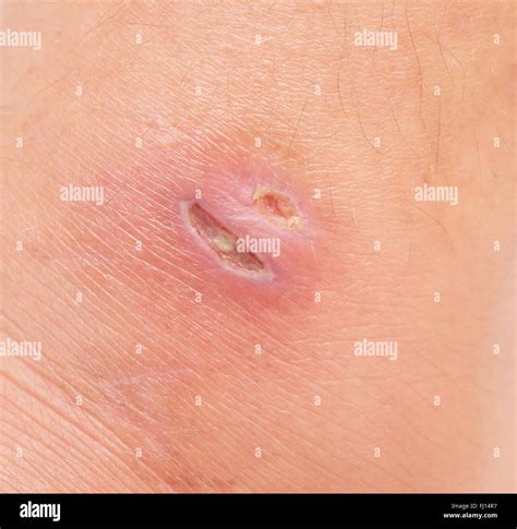 Wound On Human Skin Stock Photo Alamy