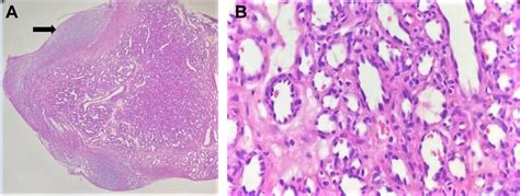 Intravascular Lobular Capillary Hemangioma Of The Temporal Artery Journal Of Vascular Surgery