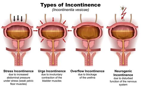 The Link Between Pelvic Floor Physical Therapy And Urinary Incontinence