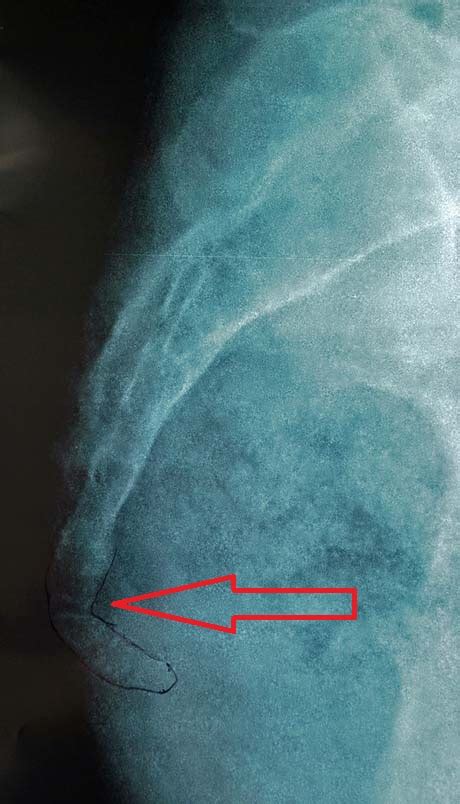 TAILBONE INJURY - COCCYX PAIN - COCCYDYNIA | GEORGE D. GOUDELIS MD. Ph.D.