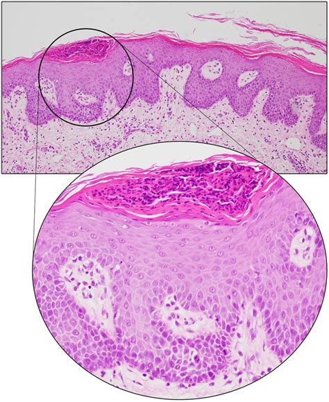 Skin Biopsy From Patient No 2 Showing Hyperplastic Epidermis With