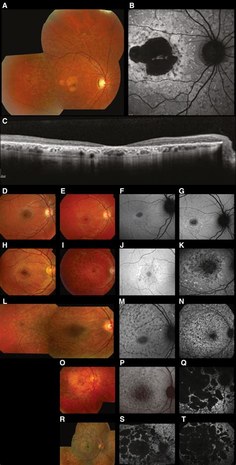 Representative Cases Of Stargardt Disease Stgd1 Typical Findings Of Download Scientific