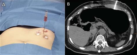 SciELO Brasil Computed Tomography Guided Percutaneous Gastrostomy