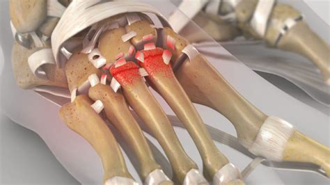 Lisfranc Fracture Motus Physical Therapy