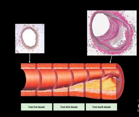 L19 Cardiovascular Research Topics And Peripheral Vascular Disease