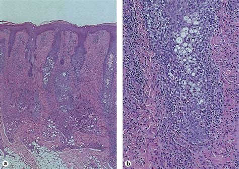 Figure From Eosinophilic Pustular Folliculitis With Polycythemia Vera