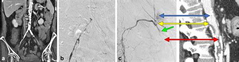 Rescue Aortoiliac Subintimal Recanalization And Stent Endobypass For