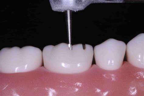 Occlusal Surface Of Tooth