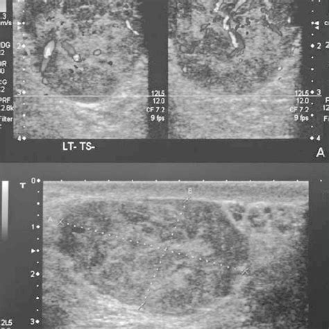 A Is A Scrotal Ultrasound Showing A Well Circumscribed Lesion Of Mixed