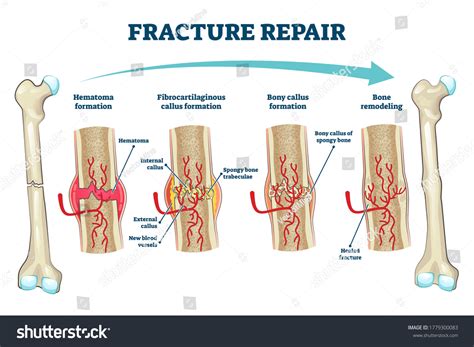 Fracture Repair Educational Bone Remodeling Formation Stock Vector ...