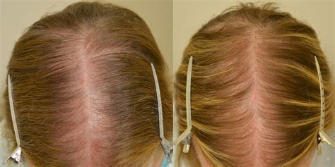 Finasteride Females Before And After Photos Hair Restoration Of The South New Orleans La