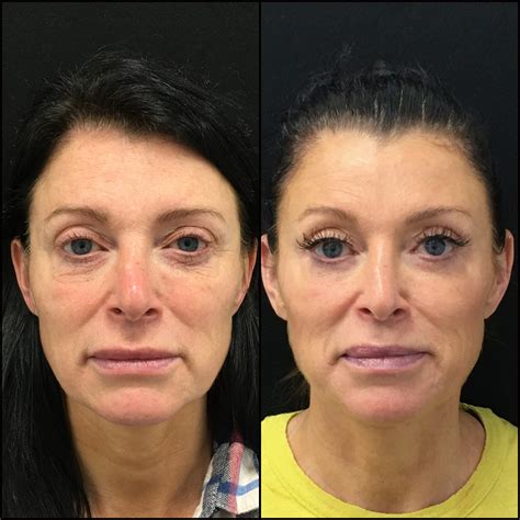 Lower Blepharoplasty Gone Wrong