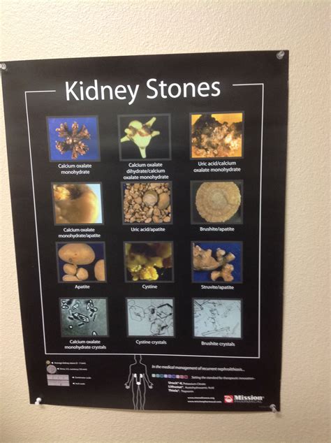 Actual Kidney Stone Size Chart In Mm Teretricks