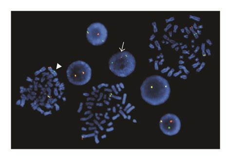 Cytogenetic Analysis Of Bone Marrow A The G Banded Metaphase Cell