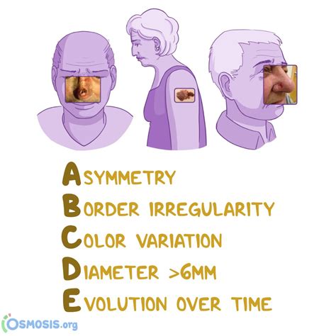 Osmosis From Elsevier On Twitter Happy Dont Fry Day Yes We Mean