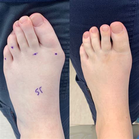 Before and After Bunion Surgery Photos | The Bunion Cure