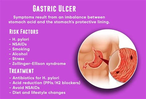 Gastric Ulcer Symptoms, Causes & Treatment - Dr. Patta