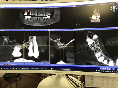 Dental Implants Bright Dental Charlotte Matthews Nc Dentist