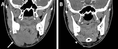 Hard Swelling In The Right Submandibular Region Of An Year Old