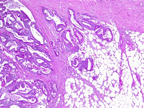 [figure Colorectal Cancer With Pathological T3 ] Statpearls Ncbi