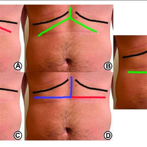 Different Types Of Incisions Used In Hpb Surgery A Lines Of