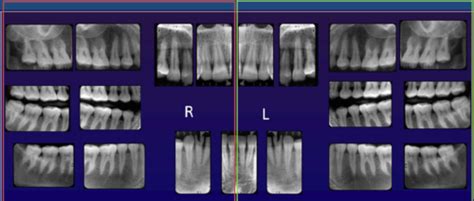 Intraoral Projections Flashcards Quizlet