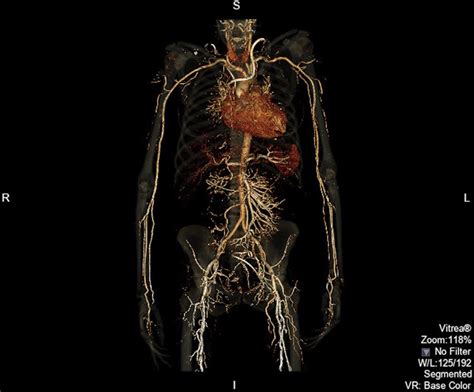 Computed Tomography Ct Angiography Showed Circumferential Calcified