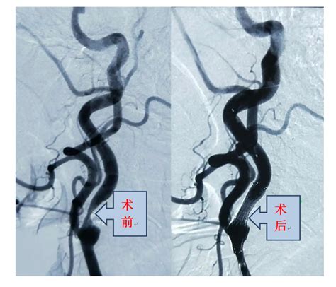 疏通生命之道 我院神经外科成功开展颈内动脉支架植入术