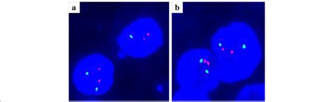 Chromosome 1p And 19q Co Deletion Analysis Neither 1p A Nor 19q B