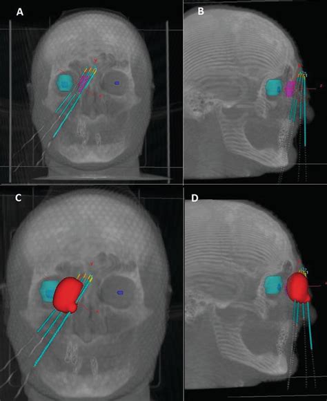 Treatment Planning In Brachytherapy Hdr Based On Three‐dimensional