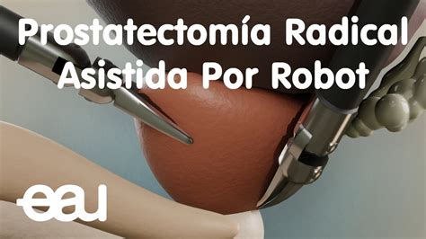 Prostatectomía Radical Asistida Por Robot Youtube