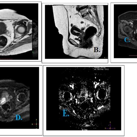 Seventy Year Old Female Patient Presenting With Post Menopausal