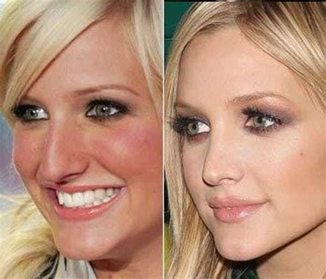 Celebrities Nose Jobs Before And After Photos