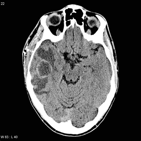 Cerebral Abscess Image