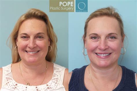 Facelift And Mini Facelift In Orlando Fl Dr George Pope