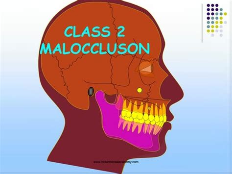 Angles Class 2 Malocclusion