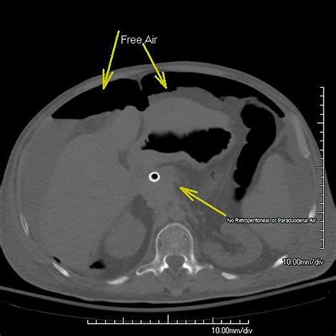 Retroperitoneal Air