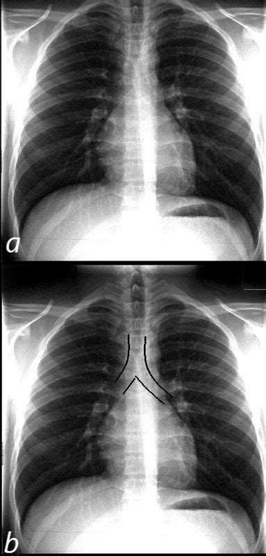 Carina Lung Xray