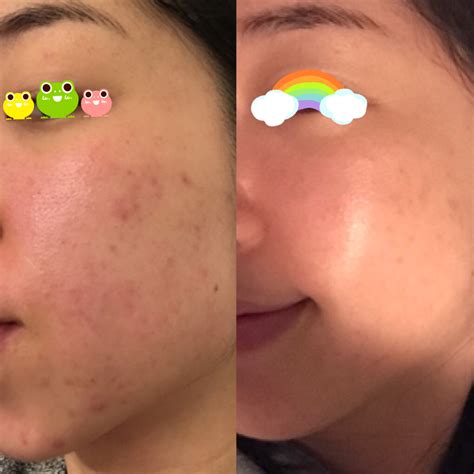 Glowing Skin Before And After