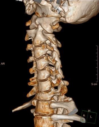 Hyperflexion Cervical Spine Injury Flexion Teardrop Fracture Image