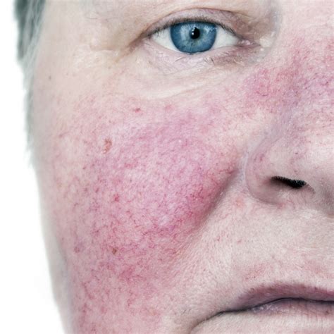 Telangiectasia Rosacea