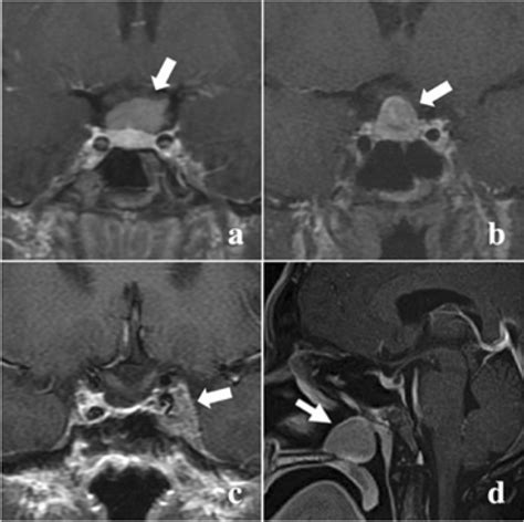 Mri Of Patient A Showing A Suprasellar Mass Arrow Mri Of Patient