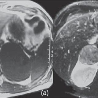 Rm Imagens Axiais T A E T B De Les O Adrenal Bilateral Em