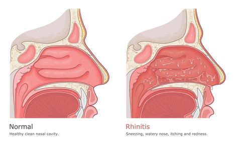 Is Sinusitis Always A Chronic Condition Maryland Ent