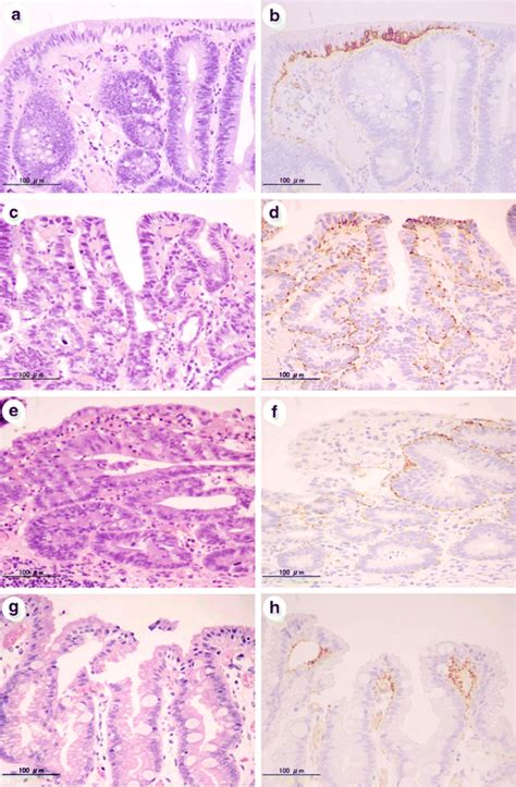 Adipophilin Expression In Gastric Epithelial Neoplasia And Background