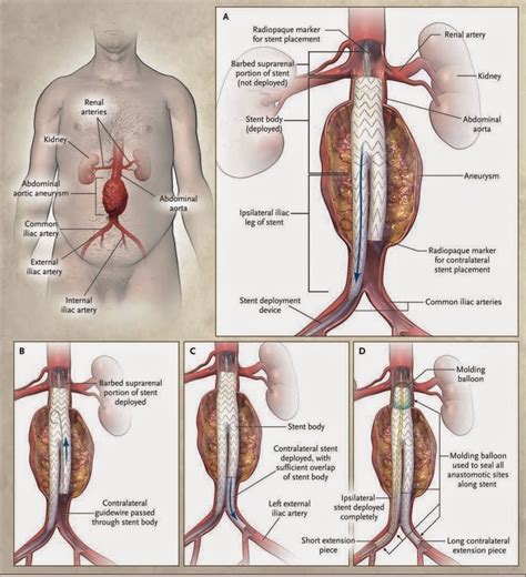 Manuali Di Medicina Intensiva Chirurgia Ad Alto Rischio Aneurismi