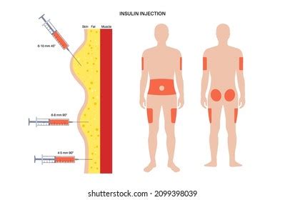 Diabetes Treatment Insulin Injection Sites On Stock Vector (Royalty ...